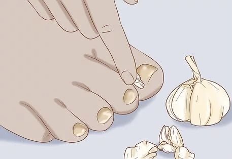 Toenail affected by fungus